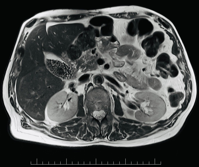 Abdominal/pelvic MRI example used to illustrate ovarian cancer staging
